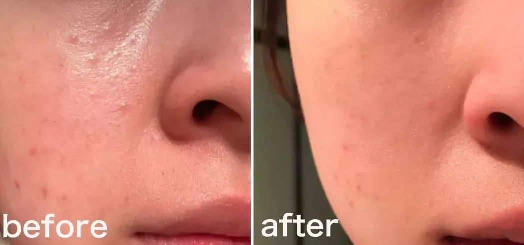 祛斑美白补水祛皱祛痘,祛斑祛痘美白改善暗沉