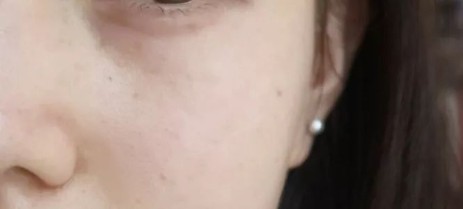 5个祛斑小妙招淡化晒斑雀斑痘印,晒斑痘印怎么消除的最快方法