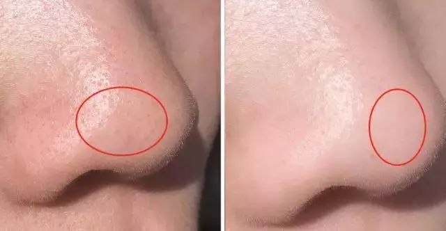 用了几天火山泥为什么还毛孔粗大,怎样用韩国进口火山泥洗脸