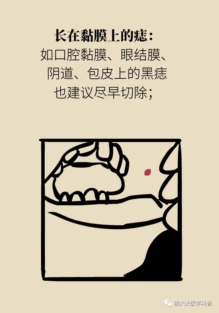 什么症状表明痣已经在恶变,先天性黑素细胞痣恶变的概率大吗