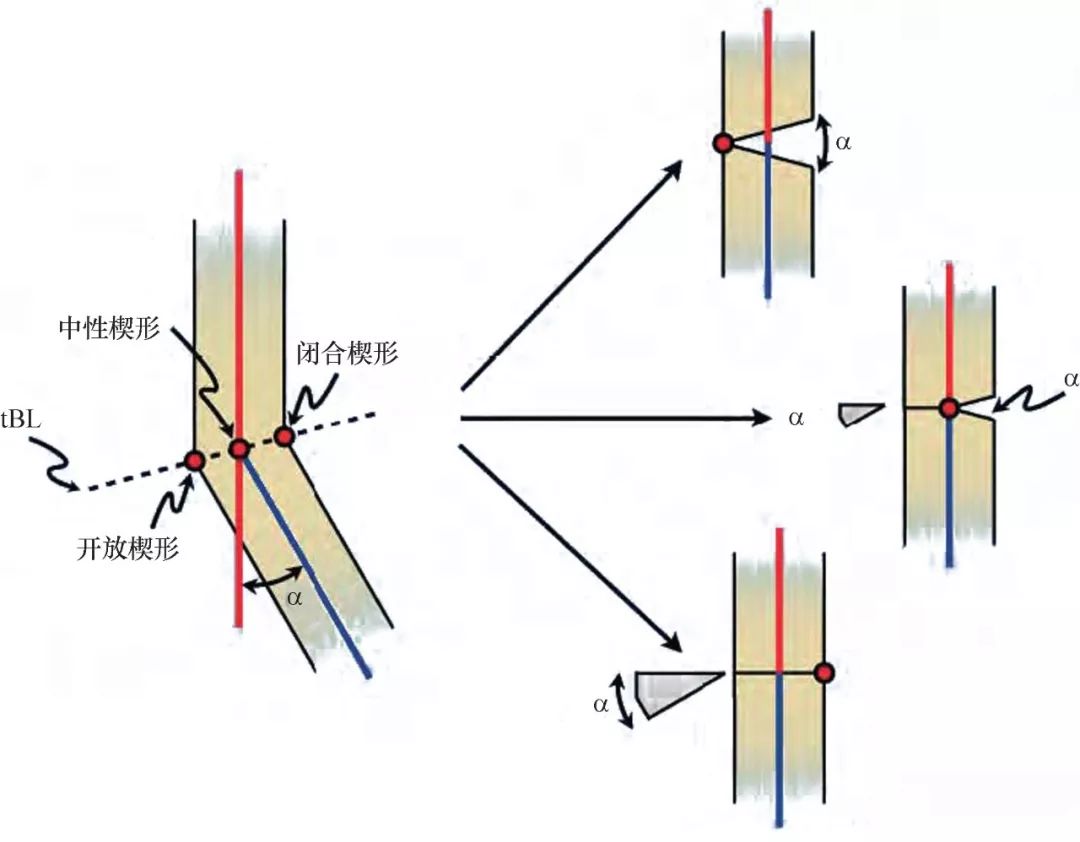 taylorswift支架,taylor外固定支架