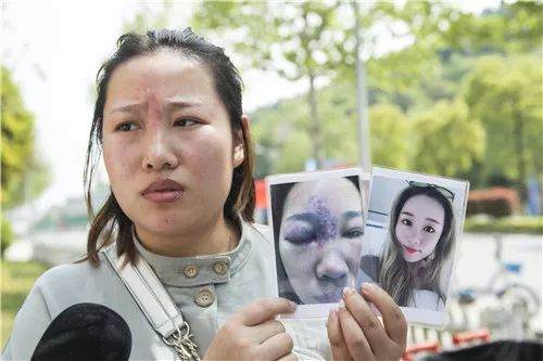 女子鼻部注射玻尿酸导致失明,打玻尿酸隆鼻子失败案