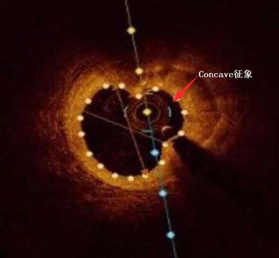 oct閽欏寲鐥呭彉,cit2019灞曚細瑙嗛