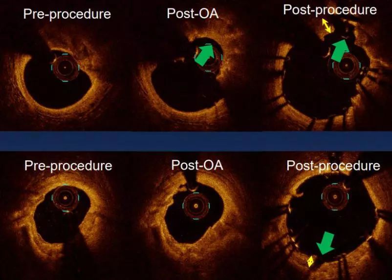oct閽欏寲鐥呭彉,cit2019灞曚細瑙嗛