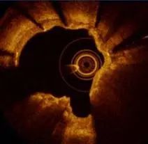 CIT2019｜李妍教授：OCT指导钙化病变，这些精髓要知道