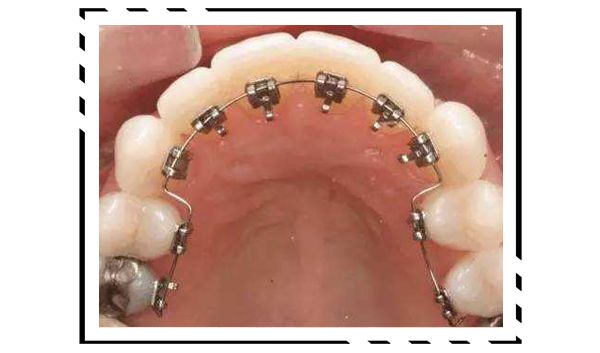 戴牙套换粗钢丝,拔四颗牙戴牙套的脸型变化图