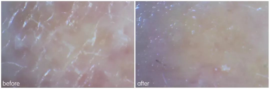 灏忚寕鑲岃瘖瀹よˉ姘村悧,灏忚寕鑲岃瘖瀹ゅ埌搴曟湁澶氬己