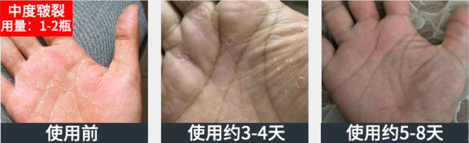 足部护理加长加热脚套,足部护理脚趾套品牌