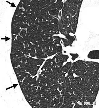 胸部解剖及常见疾病影像表现,胸部影像学基础知识