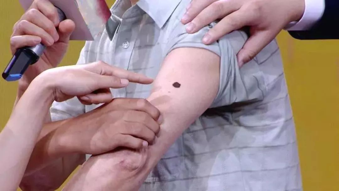 黑痣长在身上2个部位特容易癌变,什么位置的黑痣容易癌变