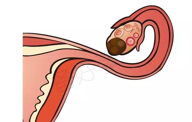 巧克力囊肿是卵巢囊肿吗,巧克力囊肿可以吃巧克力吗