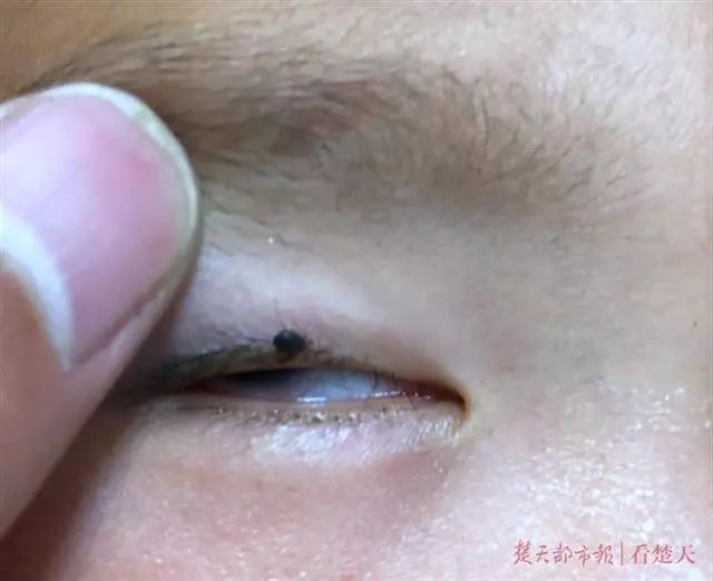 2岁的小孩眼皮突然有红点,小孩子眼皮上忽然凸起小泡泡
