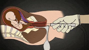 无痛人流就是“无损伤”人流吗？