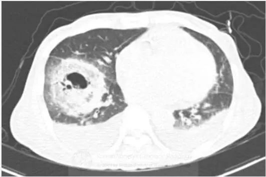 肺空洞性实变是什么原因,肺空洞症状