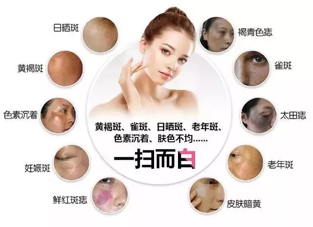 皮秒激光和调q激光哪个先进,皮秒激光消除色素沉着有效吗