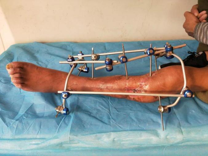 小腿部分断裂保守治疗,小腿离断再植康复训练