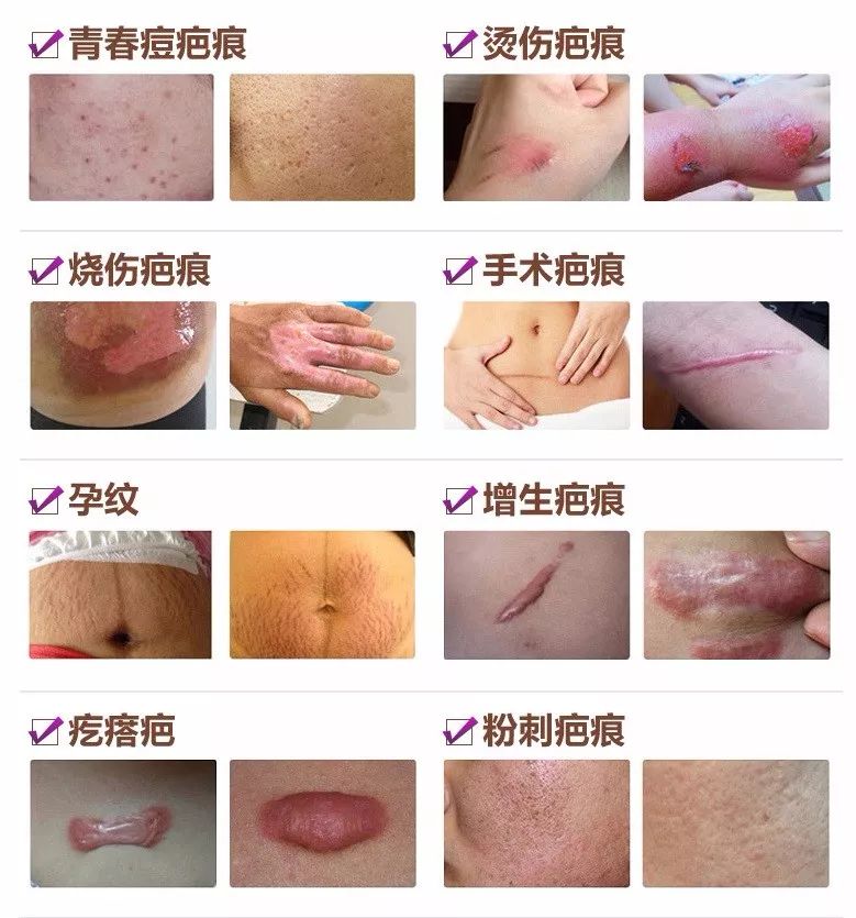 疤痕彻底消失新技术,疤痕淡化修复新技术