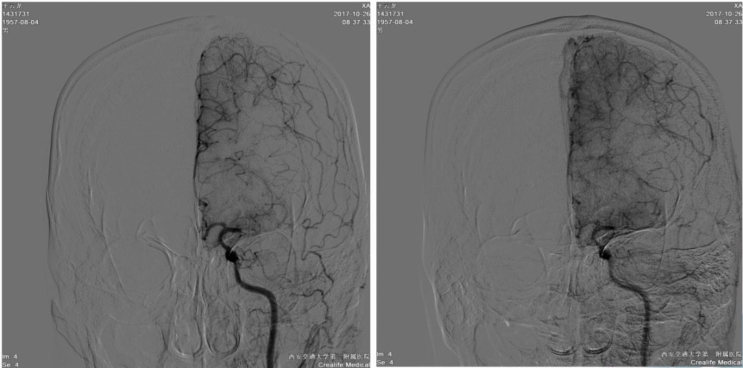 径技·例量|25期：再灌注出血—防不胜防