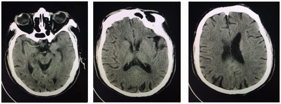 径技·例量|25期：再灌注出血—防不胜防