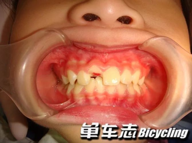 骑车摔伤牙齿松动怎么办,骑车磕到牙齿怎么办