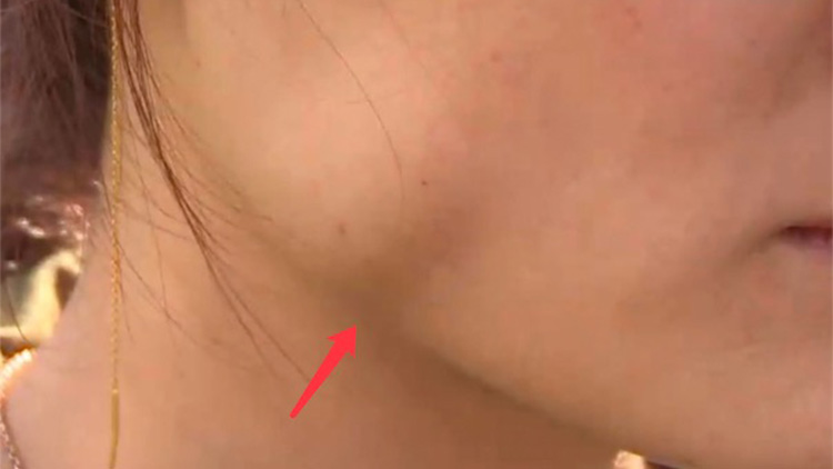 女子注射瘦脸针变成30岁的脸,注射瘦脸针后脸型变了