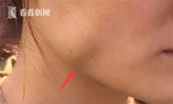女打瘦脸针后咬肌变化图,面部注射瘦脸15天后有疙瘩