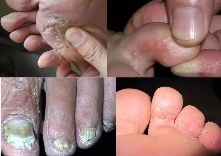 专治脚气的神奇药,十多年的脚气三味中药一招搞定