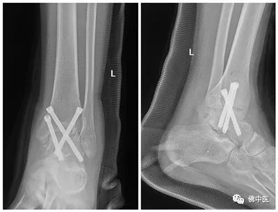 【高超】玻璃人迎来新生！佛中医多科协作成功治疗血友病性踝关节炎少年