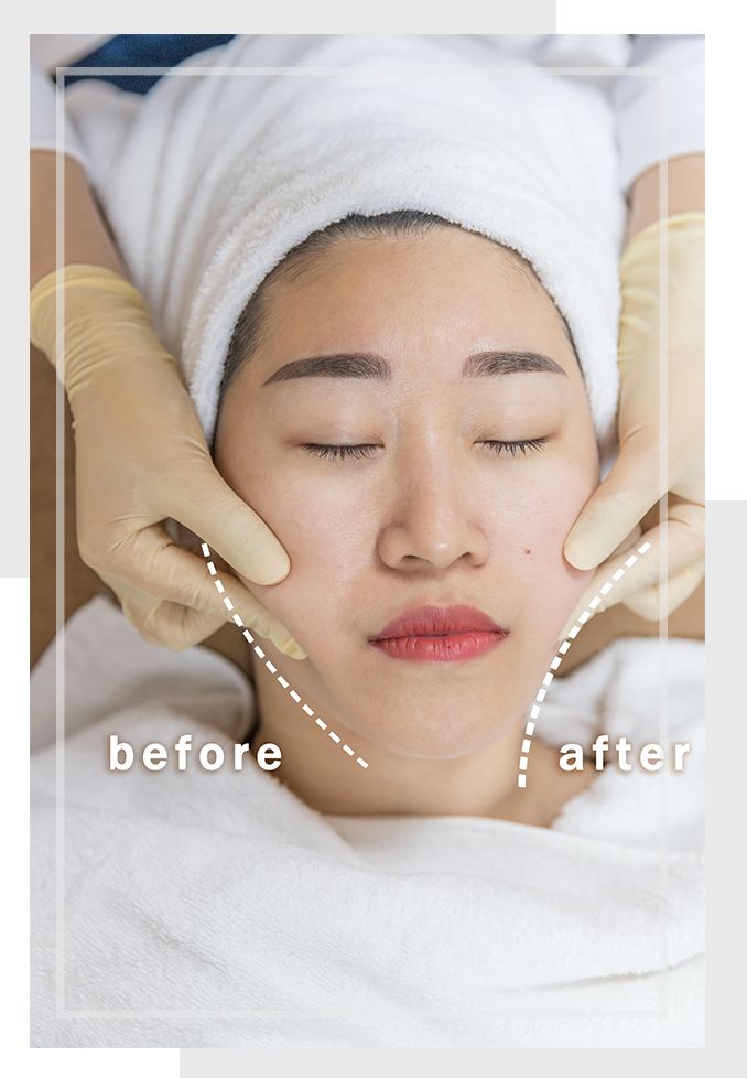 面部提拉无针埋线,无针埋线有护肤效果吗