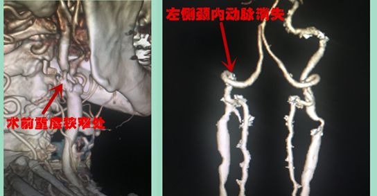 做了这个手术，肖大爷的白发变黑了……