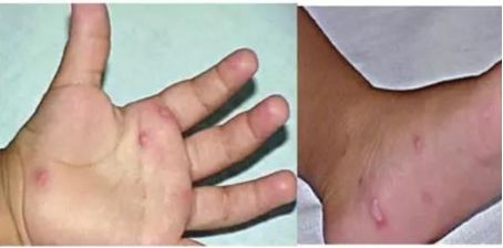 手足口病高发怎么防护看这里,现在是手足口病高发季怎么预防