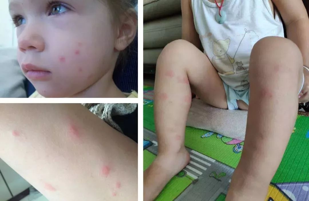 防蚊帘爆开如何处理掉,防蚊物理屏障