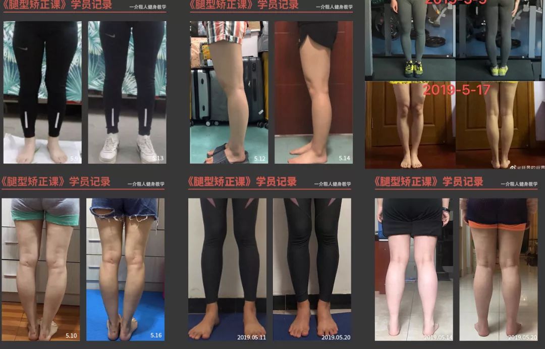 腿粗还不直小腿还外翻,怎么走路小腿才不会粗