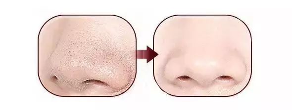 怎么把脸上的黑头清掉,去黑头推荐全脸