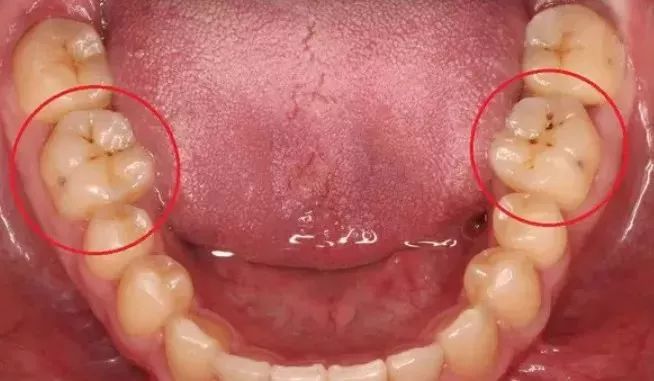 牙齿表面上有黑点点刷不掉怎么办,牙齿上的黑点刷不掉是什么原因