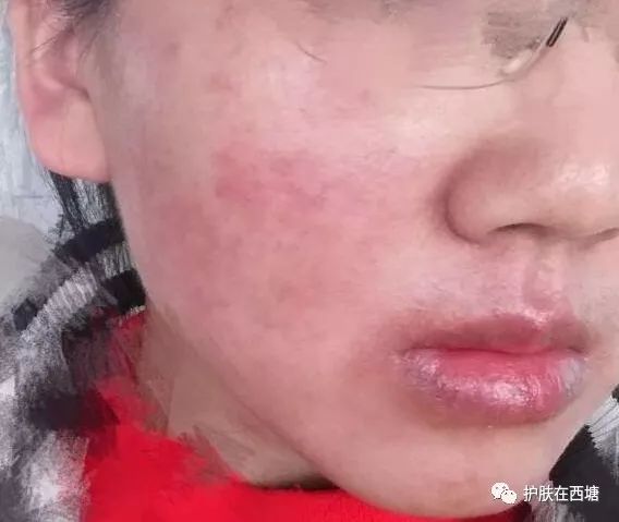 关于皮肤皮炎的几种症状,面部激素依赖性皮炎能好吗