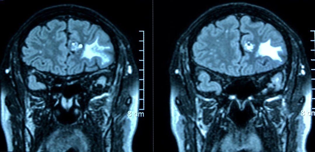 头痛医生说脑子长东西了,头疼头晕是脑袋里长什么东西了