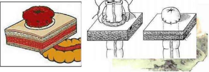 造口患者标准护理流程,造口的正确护理方法