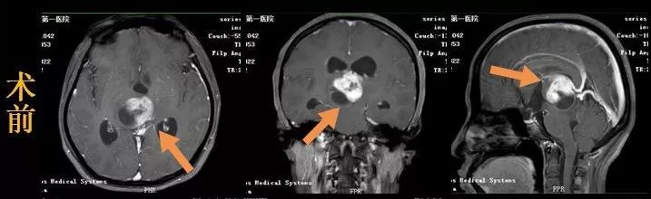 38岁女人每晚做梦是什么原因,42岁女得脑胶质瘤
