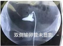 治不孕不育案例,专治不孕不育输卵管疏通祖传秘方