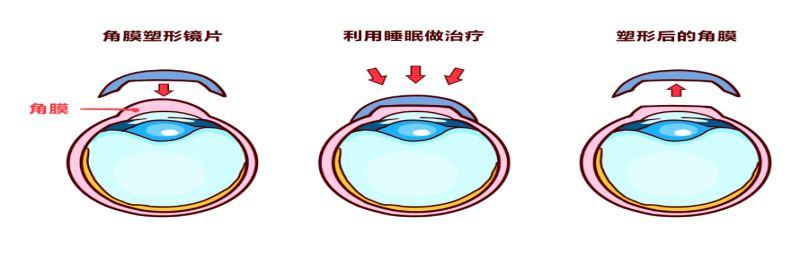 两岁半儿童近视怎么补救最快,900度近视怎么做近视手术