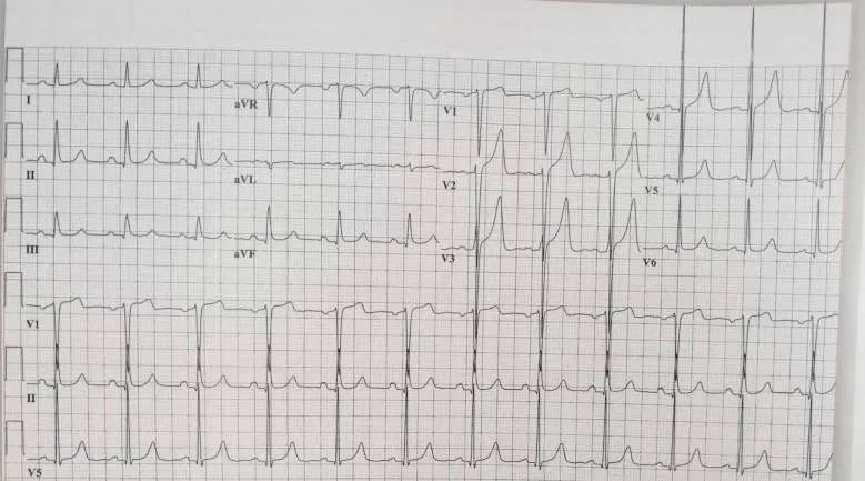 心电图上一个小格代表什么,心电图上有小波动你会怎么样