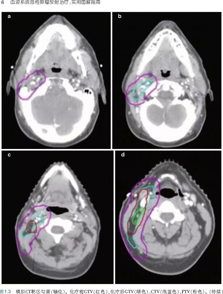 图解血液系统恶性肿瘤放射治疗，如此清晰的指南你见到过吗？