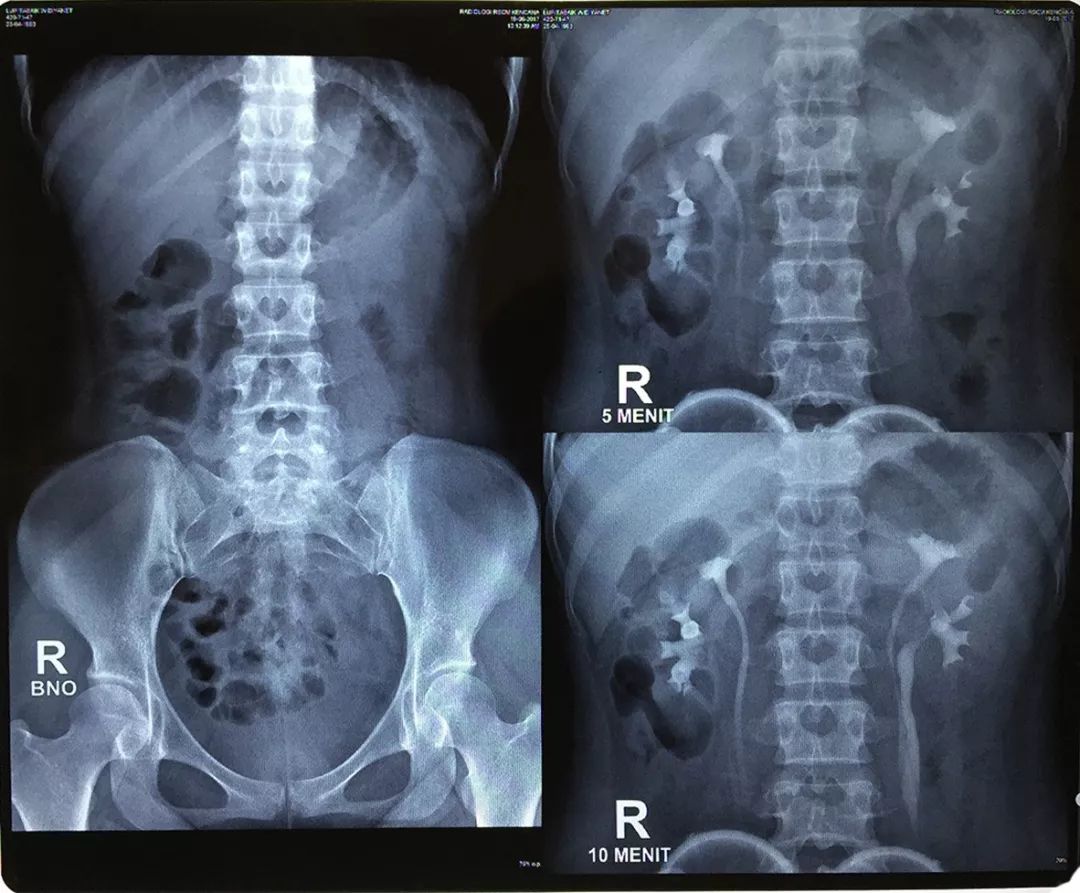 一个肾脏两条输尿管？这类肾移植该怎么做？|手术图解