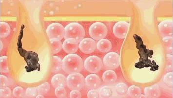 教你1分钟清除99%的脸上螨虫,10秒祛螨虫的药膏