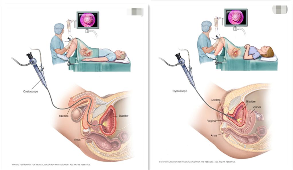 女性尿频繁还有血是什么原因,尿中带血有什么治疗偏方