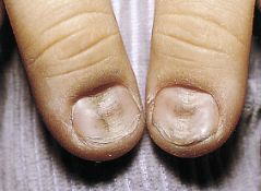 指甲很脆是因为缺少什么营养素,婴儿指甲特别脆是缺乏营养么