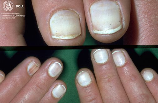 指甲很脆是因为缺少什么营养素,婴儿指甲特别脆是缺乏营养么