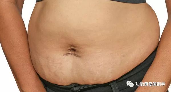 产后腹部突出很严重怎么瘦,产后大肚子怎么变形