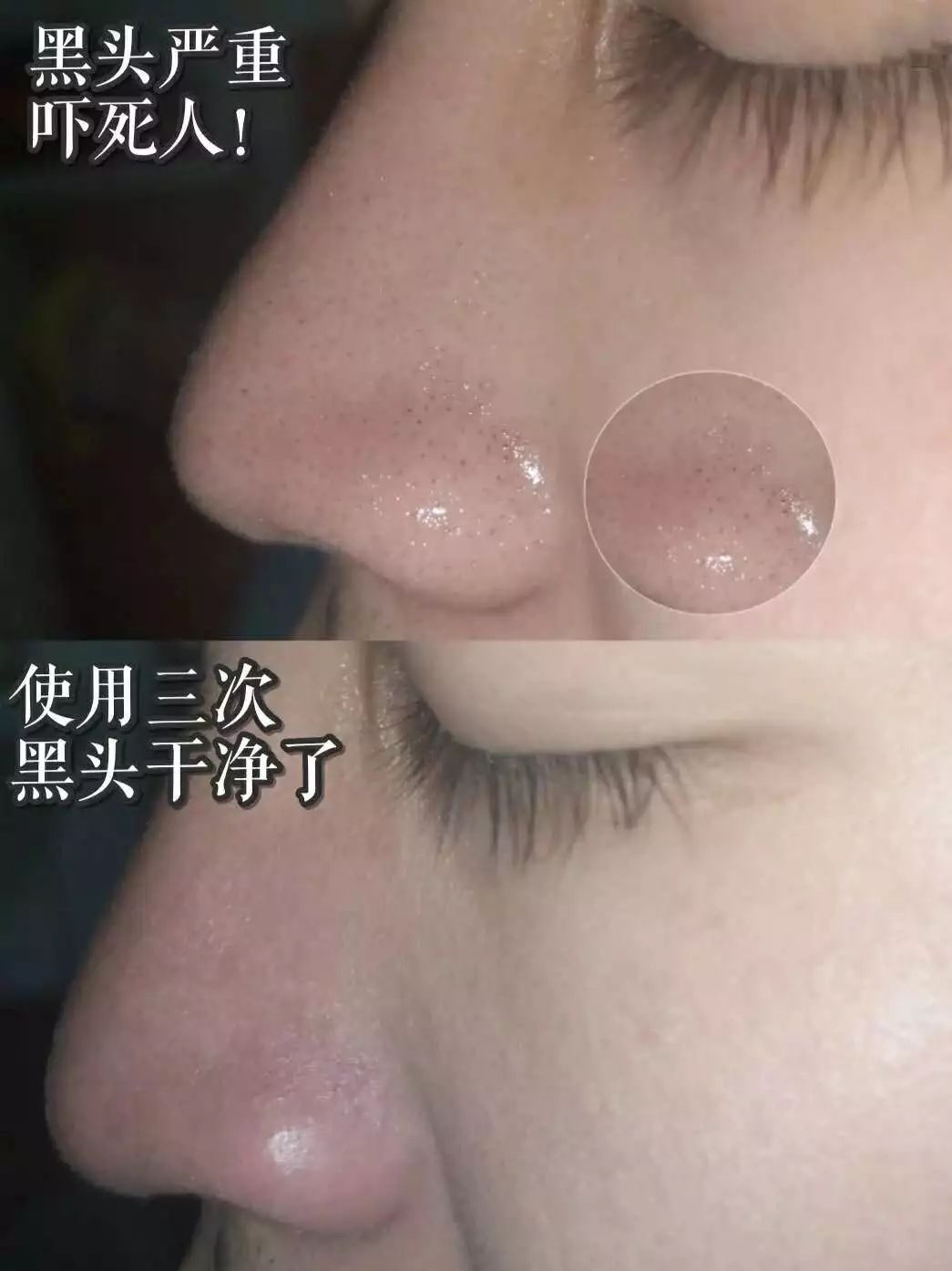 拯救毛孔黑头,清除黑头大毛孔的利器